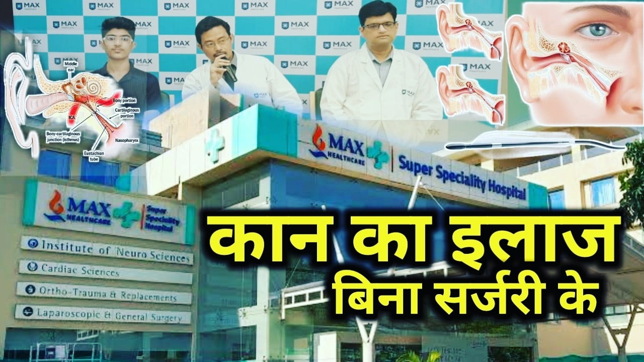 उत्तराखंड में पहली बार यूस्टेशियन ट्यूब बैलून डाइलेशन टेक्नोलॉजी का इस्तमाल, मैक्स अस्पताल ने बंद हो गए कान को खोला बिना सर्जरी के | Balloon dilation of the Eustachian tube in Max hospital 15 Balloon dilation of the Eustachian tube in