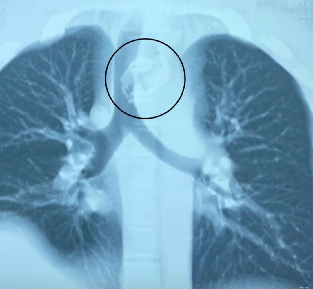 इंद्रेश अस्पताल का एक और करिश्मा, ब्लेड निकाल बचाई जान | Indresh Hospital Save Patient Life 4 Indresh Hospital Save Patient Life