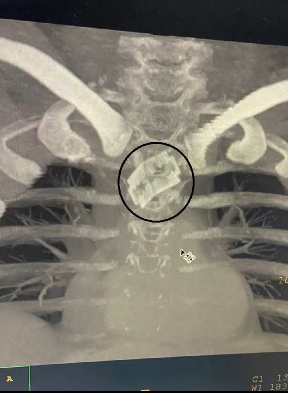 इंद्रेश अस्पताल का एक और करिश्मा, ब्लेड निकाल बचाई जान | Indresh Hospital Save Patient Life 3 Indresh Hospital Save Patient Life